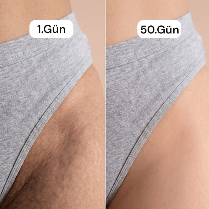 genital kararma before-after