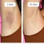 vagenmax-before-after